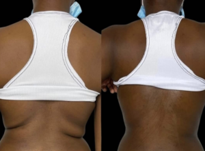 pcdc fat dissolving injections bra line results